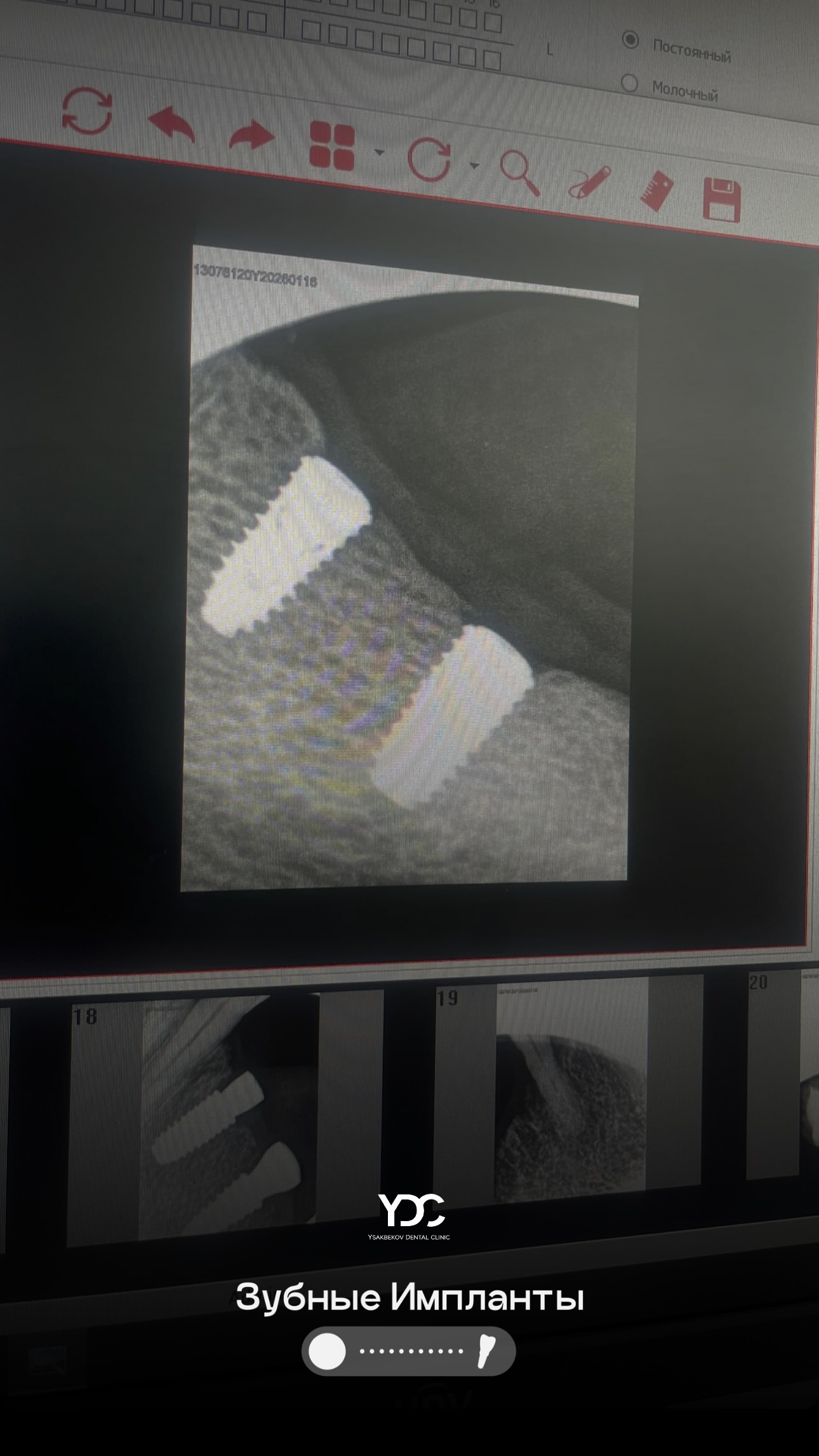 Реставрация зубов