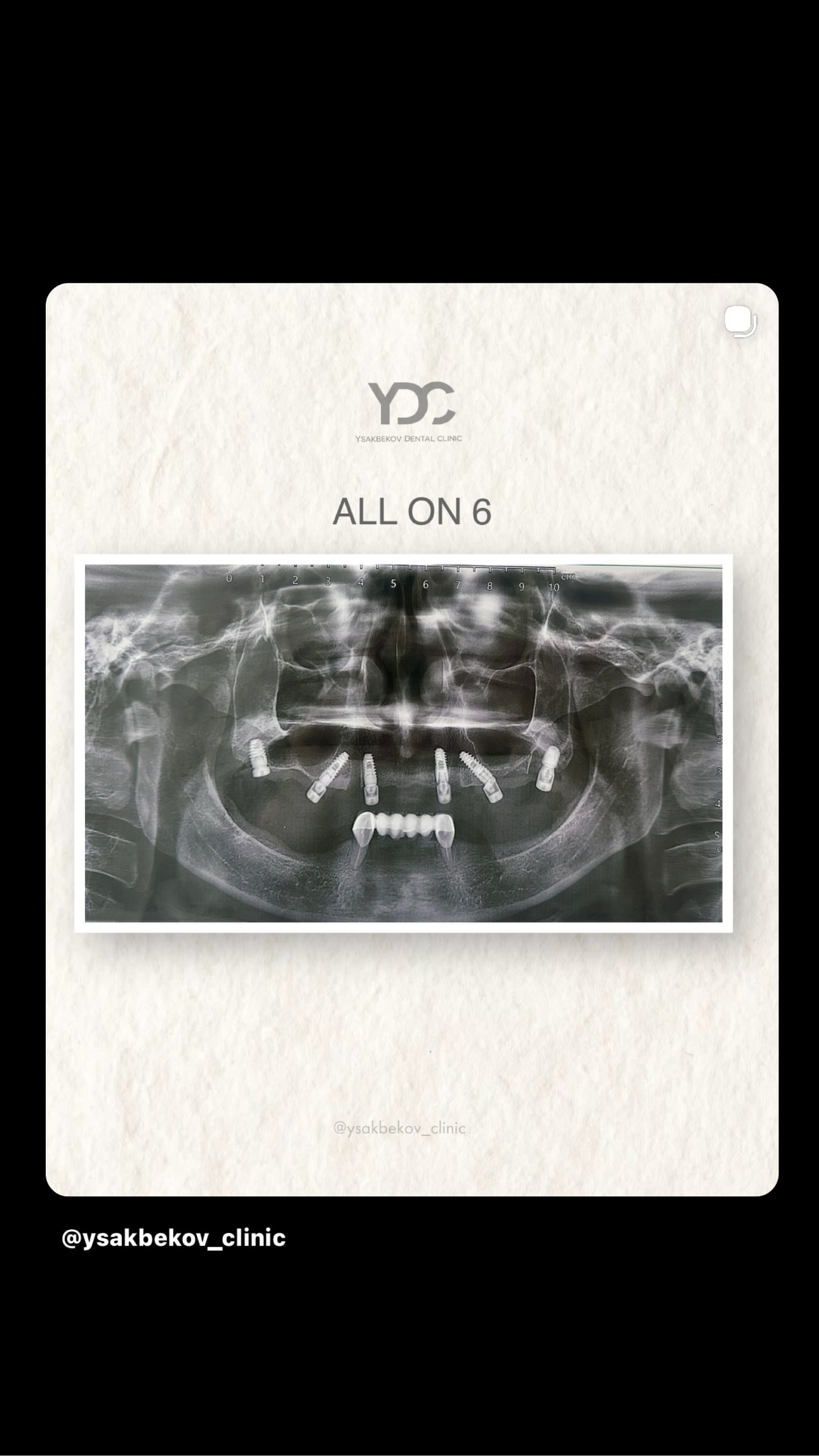 Работа с имплантами